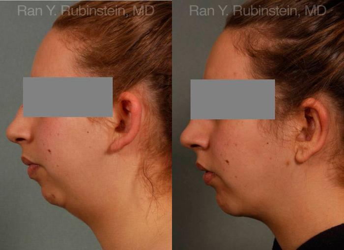 Laser Lift Precision Tx Before and After Photos in Montvale, NJ, Patient 13248
