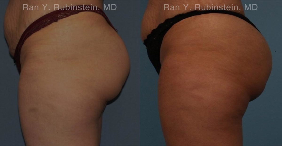 Sculptra Butt Lift Before and After Photos in Montvale, NJ, Patient 16380