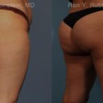 Sculptra Butt Lift Before and After Photos in Montvale, NJ, Patient 16380