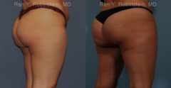 Sculptra Butt Lift Before and After Photos in Montvale, NJ, Patient 16380