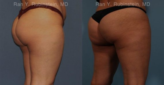 Sculptra Butt Lift Before and After Photos in Montvale, NJ, Patient 16380