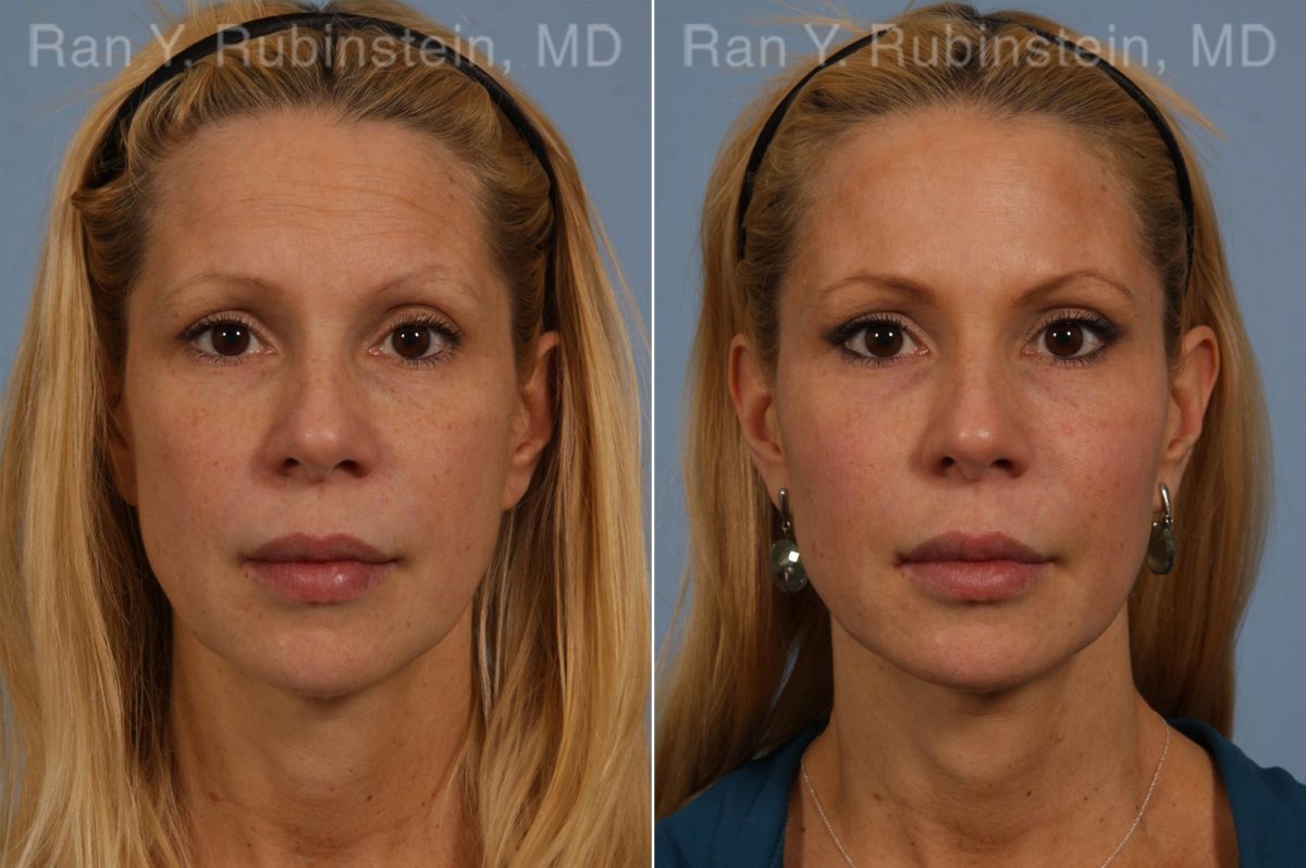 Dermal Fillers Before and After Photos in Montvale, NJ, Patient 16728