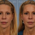Dermal Fillers Before and After Photos in Montvale, NJ, Patient 16728
