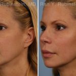 Dermal Fillers Before and After Photos in Montvale, NJ, Patient 16728