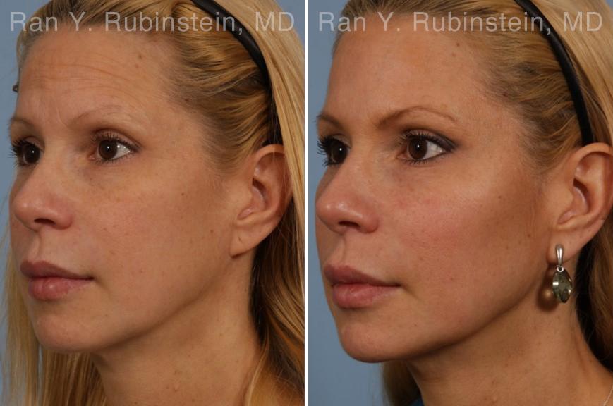 Dermal Fillers Before and After Photos in Montvale, NJ, Patient 16728