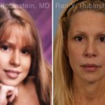 Dermal Fillers Before and After Photos in Montvale, NJ, Patient 16728