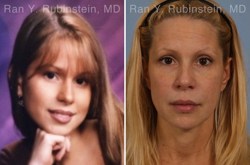 Dermal Fillers Before and After Photos in Montvale, NJ, Patient 16728