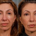 Sculptra Face Before and After Photos in Montvale, NJ, Patient 12747