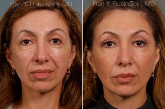 Sculptra Face Before and After Photos in Montvale, NJ, Patient 12747