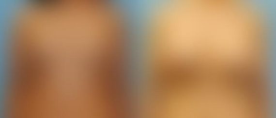 Breast Augmentation Before and After Photos in Montvale, NJ, Patient 12299