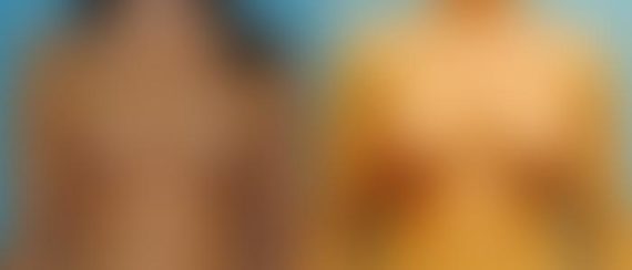 Breast Augmentation Before and After Photos in Montvale, NJ, Patient 12304