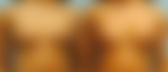 Breast Augmentation Before and After Photos in Montvale, NJ, Patient 12309