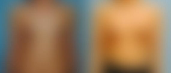 Breast Augmentation Before and After Photos in Montvale, NJ, Patient 12314