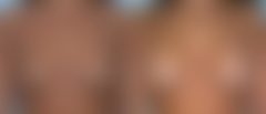 Breast Augmentation Before and After Photos in Montvale, NJ, Patient 12326
