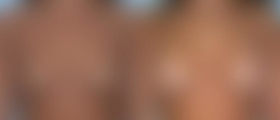 Breast Augmentation Before and After Photos in Montvale, NJ, Patient 12326