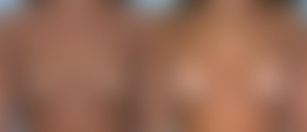 Breast Augmentation Before and After Photos in Montvale, NJ, Patient 12326
