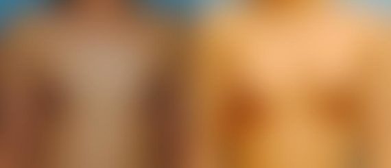 Breast Augmentation Before and After Photos in Montvale, NJ, Patient 12333