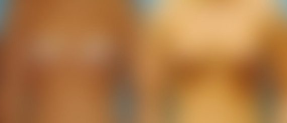 Breast Augmentation Before and After Photos in Montvale, NJ, Patient 12338