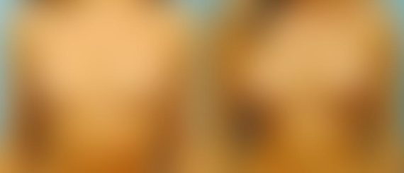 Breast Augmentation Before and After Photos in Montvale, NJ, Patient 12343