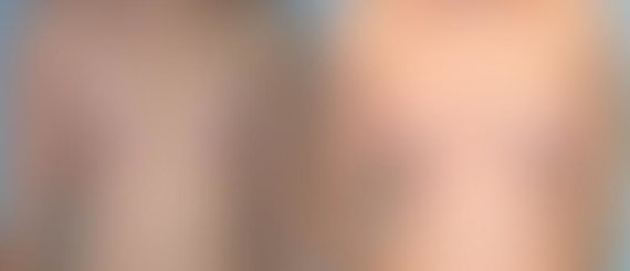 Breast Augmentation Before and After Photos in Montvale, NJ, Patient 12350