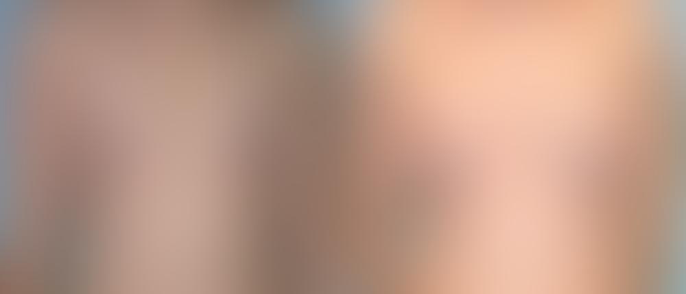 Breast Augmentation Before and After Photos in Montvale, NJ, Patient 12350