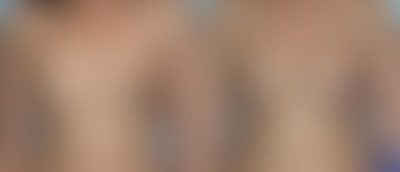 Breast Augmentation Before and After Photos in Montvale, NJ, Patient 12357