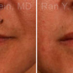 Lip Fillers Before and After Photos in Montvale, NJ, Patient 12725