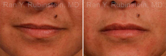 Lip Fillers Before and After Photos in Montvale, NJ, Patient 12725