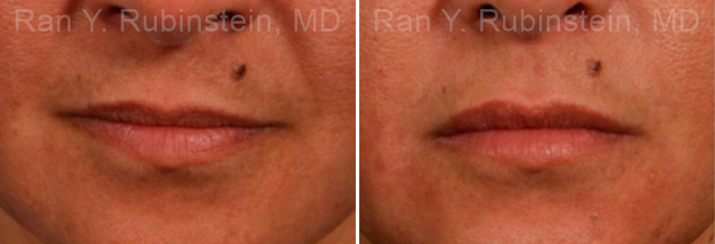 Lip Fillers Before and After Photos in Montvale, NJ, Patient 12725