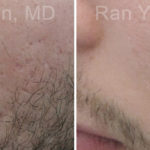 Microneedling RF Before and After Photos in Montvale, NJ, Patient 16582