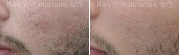 Microneedling RF Before and After Photos in Montvale, NJ, Patient 16582