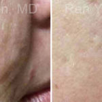 Microneedling RF Before and After Photos in Montvale, NJ, Patient 16586
