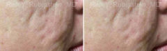Microneedling RF Before and After Photos in Montvale, NJ, Patient 16586