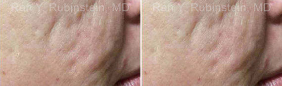 Microneedling RF Before and After Photos in Montvale, NJ, Patient 16586