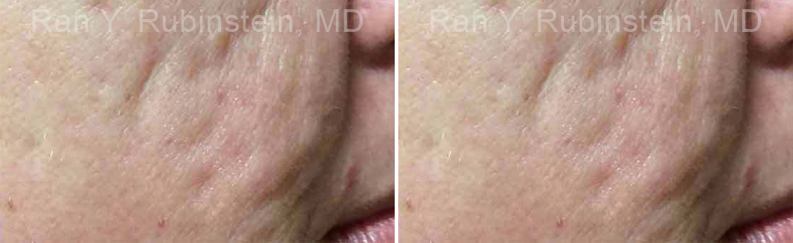 Microneedling RF Before and After Photos in Montvale, NJ, Patient 16586