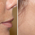Microneedling RF Before and After Photos in Montvale, NJ, Patient 16598