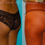 Brazilian Butt Lift Before and After Photos in Montvale, NJ, Patient 16708