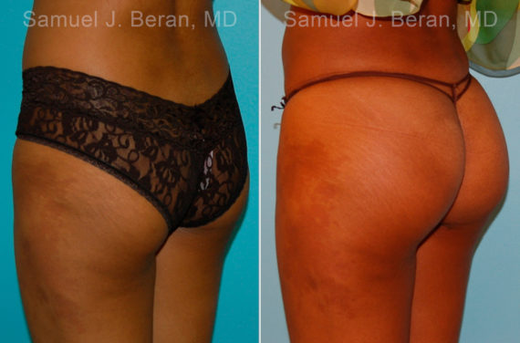 Brazilian Butt Lift Before and After Photos in Montvale, NJ, Patient 16708