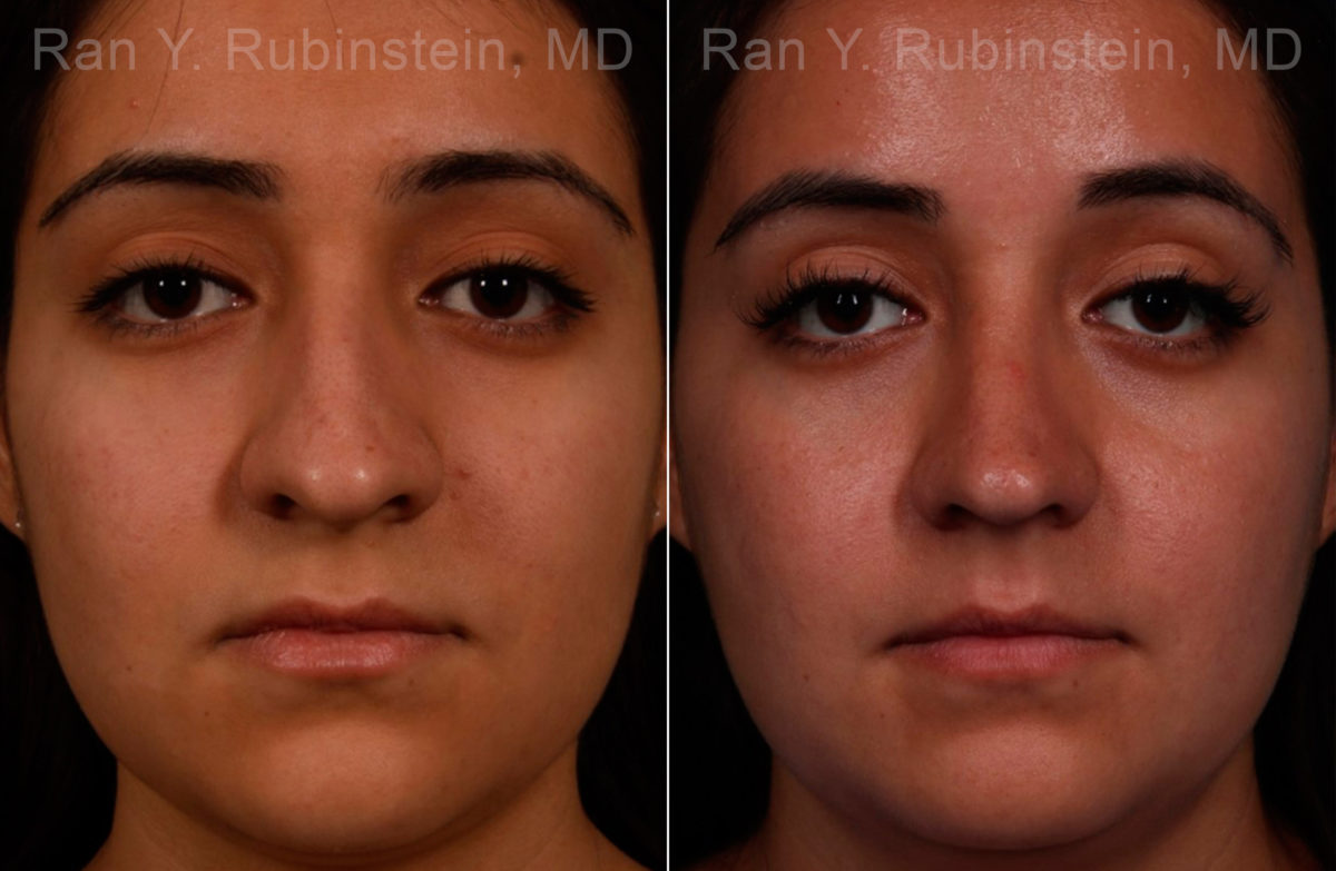 Ethnic Rhinoplasty Before and After Photos in Montvale, NJ, Patient 17240