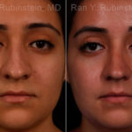 Ethnic Rhinoplasty Before and After Photos in Montvale, NJ, Patient 17240