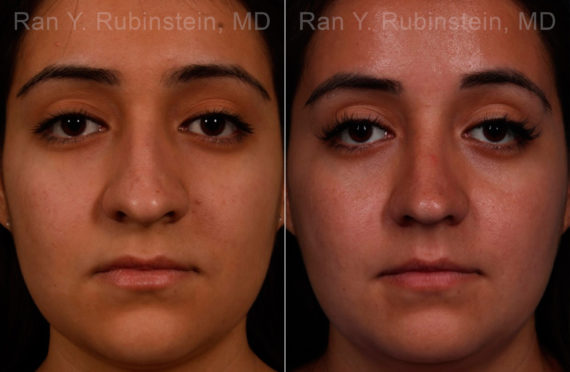 Ethnic Rhinoplasty Before and After Photos in Montvale, NJ, Patient 17240