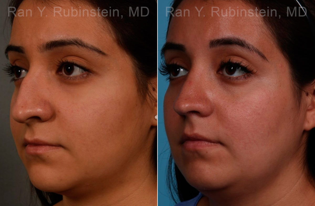 Ethnic Rhinoplasty Before and After Photos in Montvale, NJ, Patient 17240