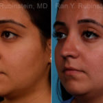 Ethnic Rhinoplasty Before and After Photos in Montvale, NJ, Patient 17240