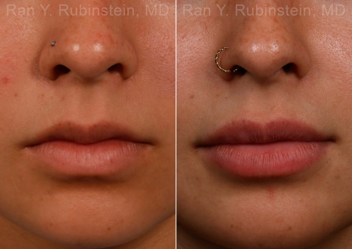 Lip Fillers Before and After Photos in Montvale, NJ, Patient 17399
