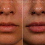 Lip Fillers Before and After Photos in Montvale, NJ, Patient 17399