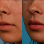 Lip Fillers Before and After Photos in Montvale, NJ, Patient 17399