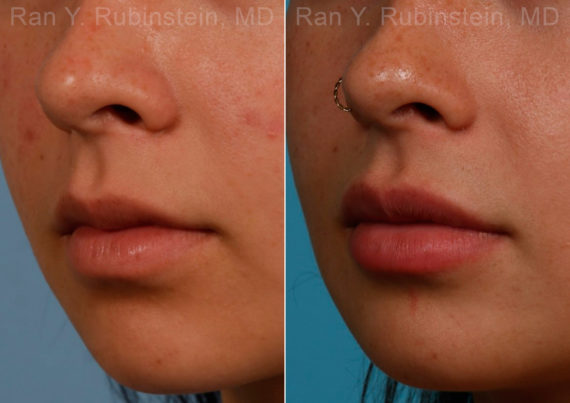 Lip Fillers Before and After Photos in Montvale, NJ, Patient 17399