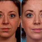 Rhinoplasty Before and After Photos in Montvale, NJ, Patient 17434