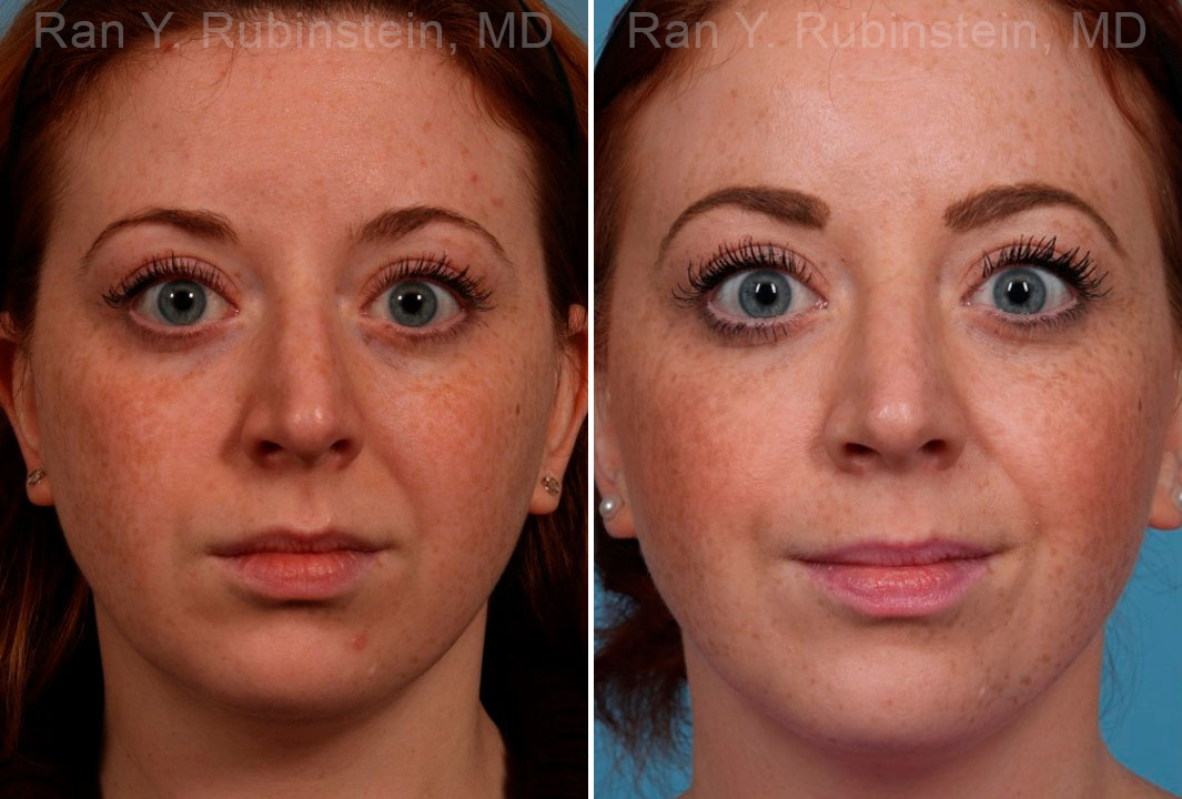 Rhinoplasty Before and After Photos in Montvale, NJ, Patient 17434