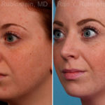 Rhinoplasty Before and After Photos in Montvale, NJ, Patient 17434